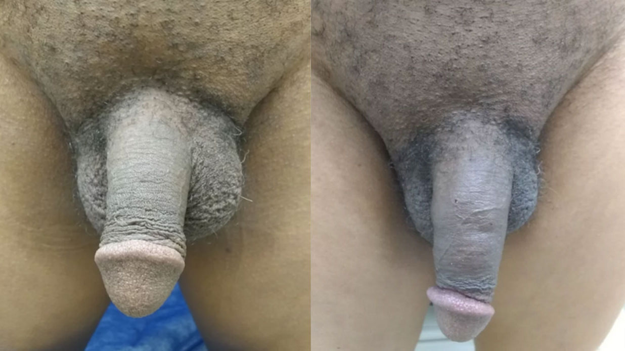 Penile Girth Enhancement Before and After Photo by Dr. Ronnie Mitchell of Erection and Enhancement Center in Southlake, TX