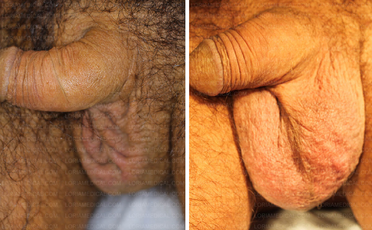 scrotal enhancement - before & after