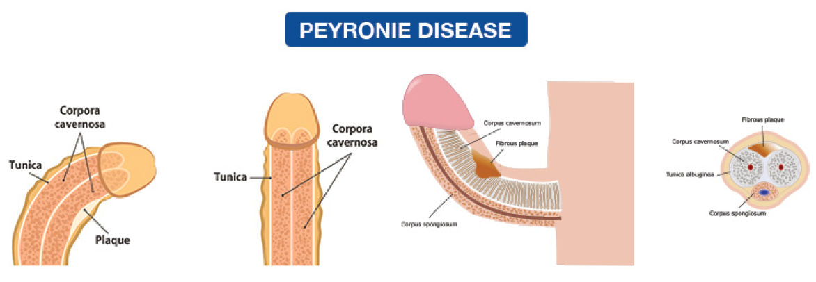 Peyronie Disease