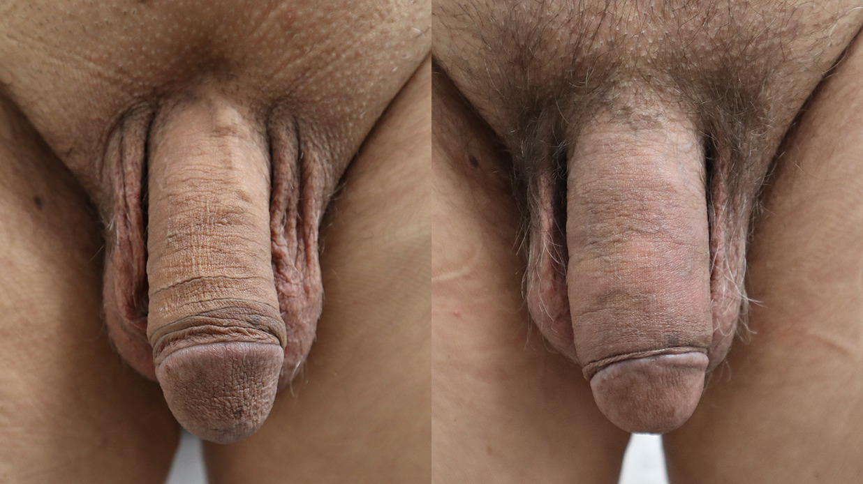 Penile Girth Enhancemenet Before and After Photo by Erection & Enhancement Center in Southlake, TX