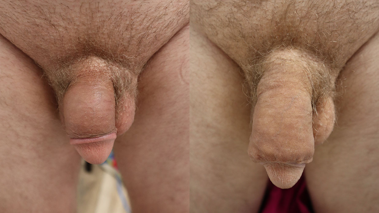 Semi-Permanent Penile Girth Before and After Photo by Erection & Enhancement Center in Southlake, TX