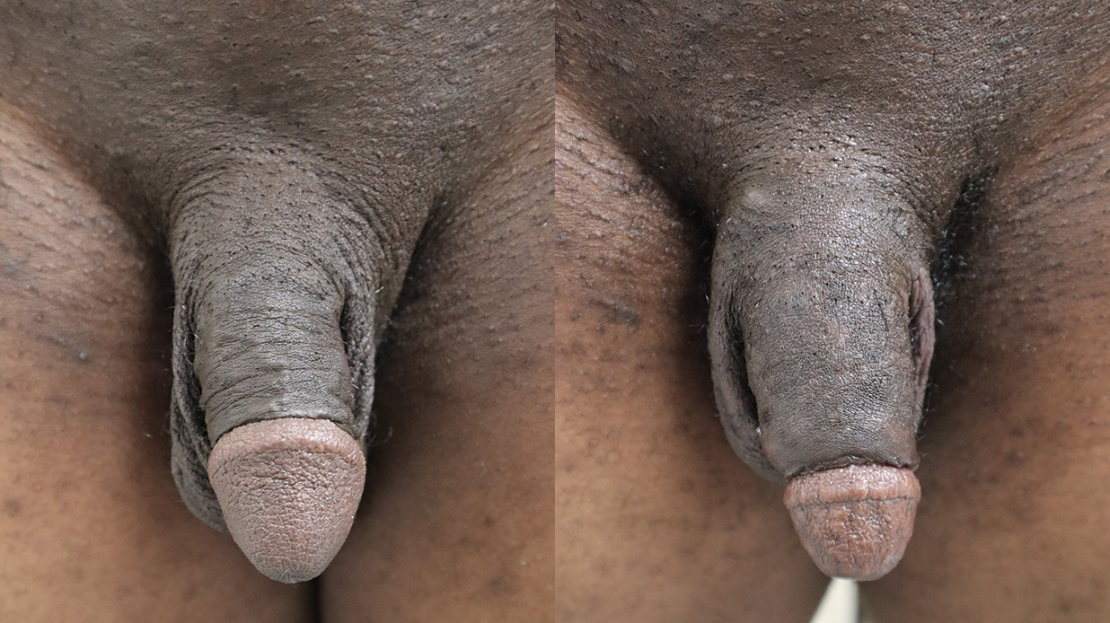 Permnanent Penile Girth Before and After Photo by Dr. Ronnie Mitchell of Erection and Enhancement Center in Southlake, TX