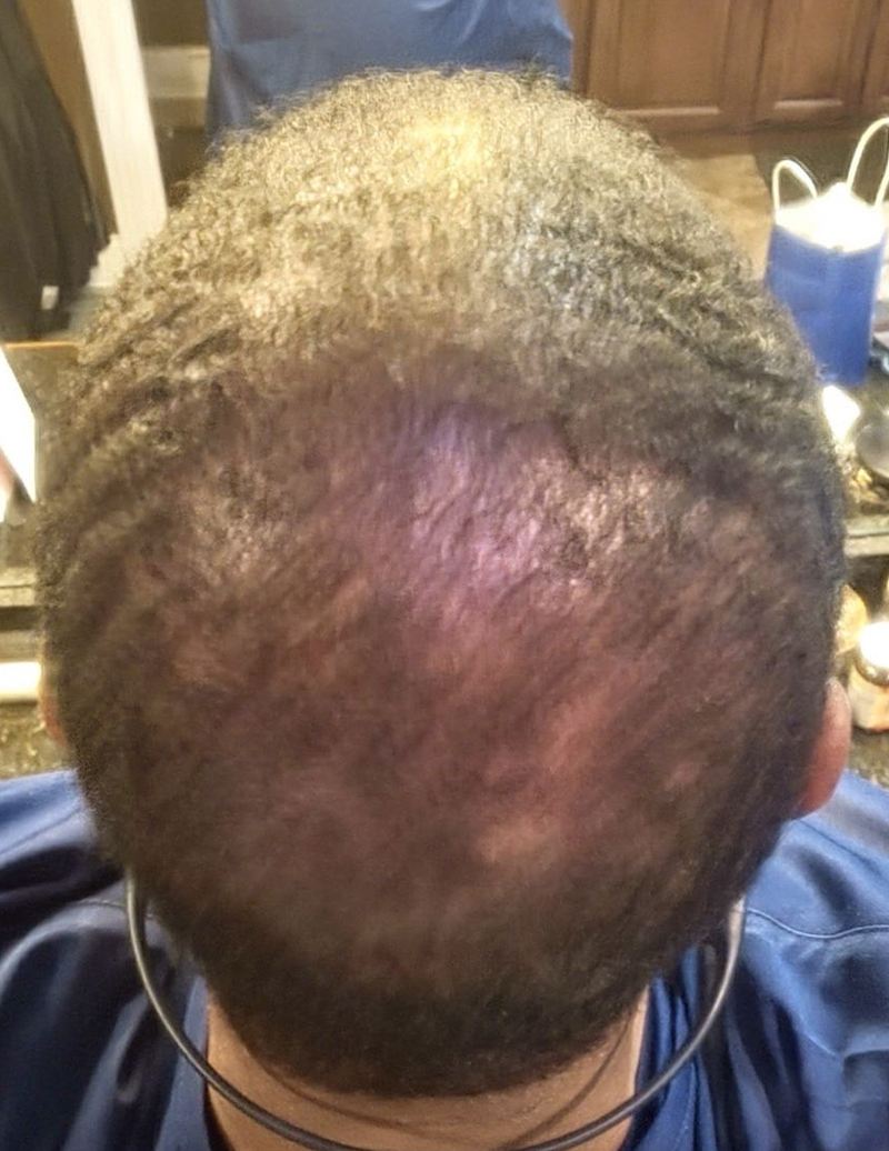 Hair Restoration After Photo by Erection & Enhancement Center in Southlake, TX