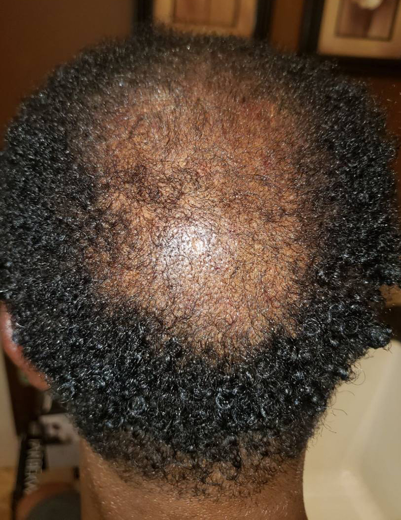 Hair Restoration Before Photo by Erection & Enhancement Center in Southlake, TX