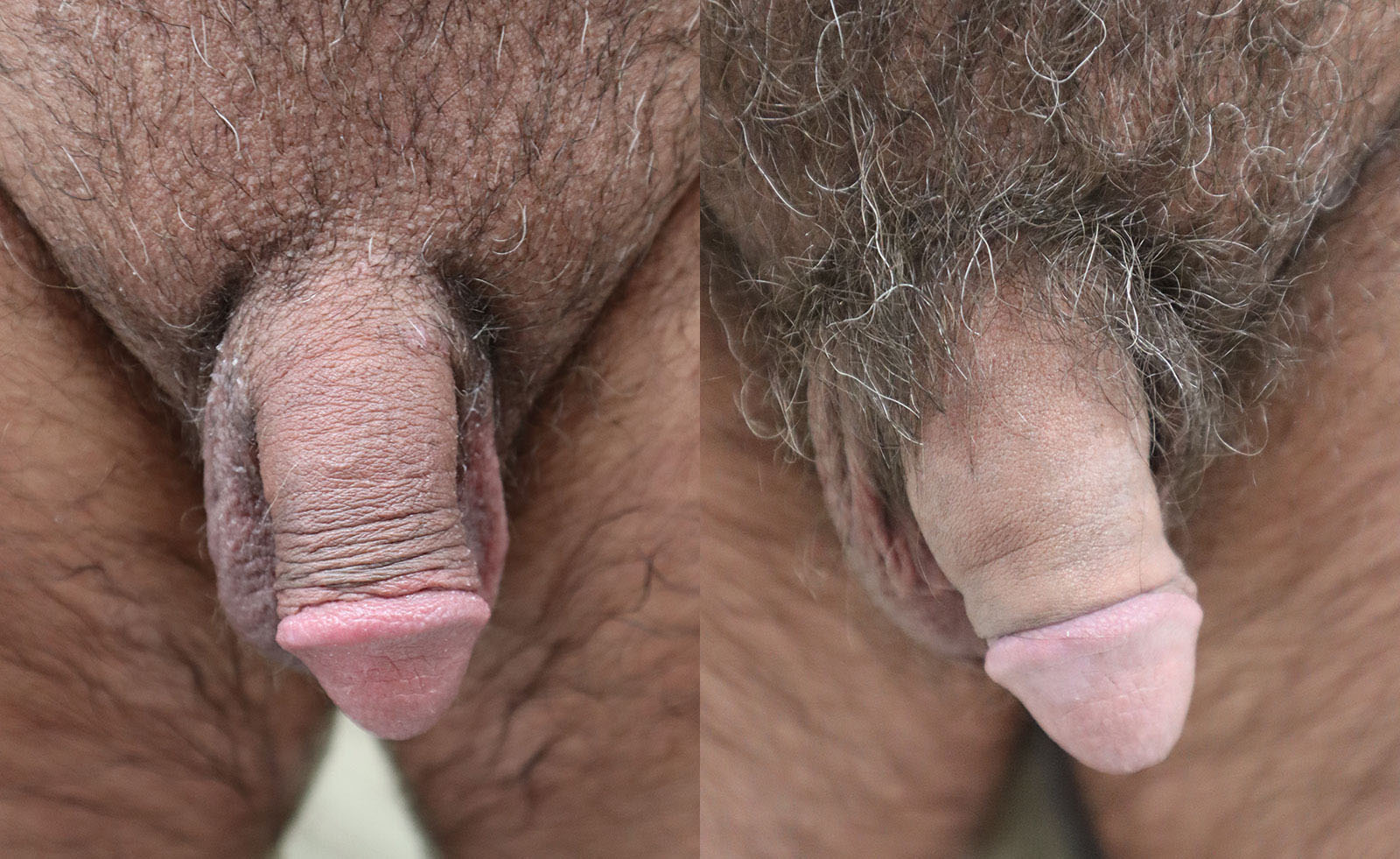 Semi-Permanent Penile Girth Before and After Photo by Erection & Enhancement Center in Southlake, TX