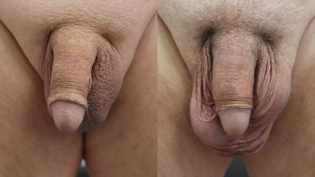 Permnanent Penile Girth Before and After Photo by Dr. Ronnie Mitchell of Erection and Enhancement Center in Southlake, TX