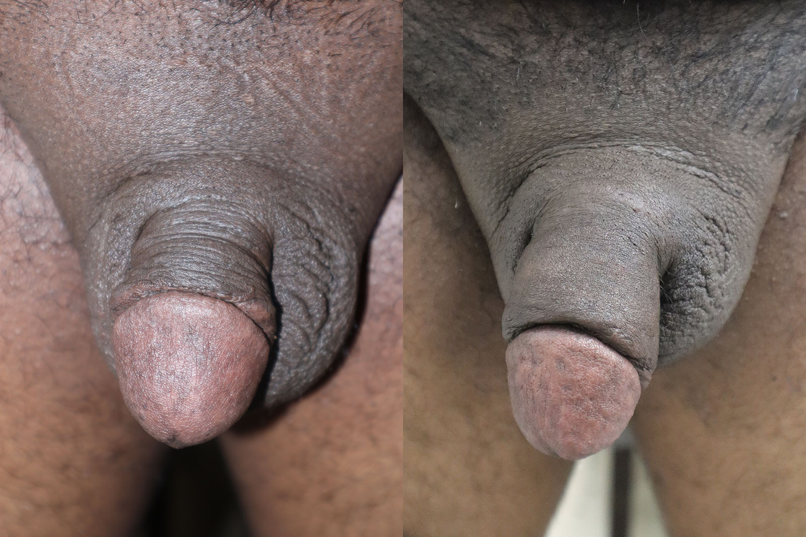 Penile Girth Enhancement Before and After Photo by Erection & Enhancement Center in Southlake, TX