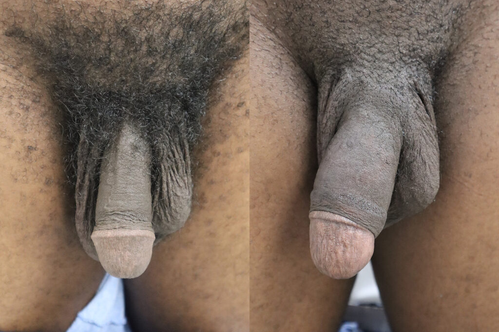Permanent Girth Before and After Photo