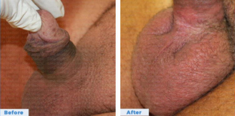 Scrotal-Before-after-1