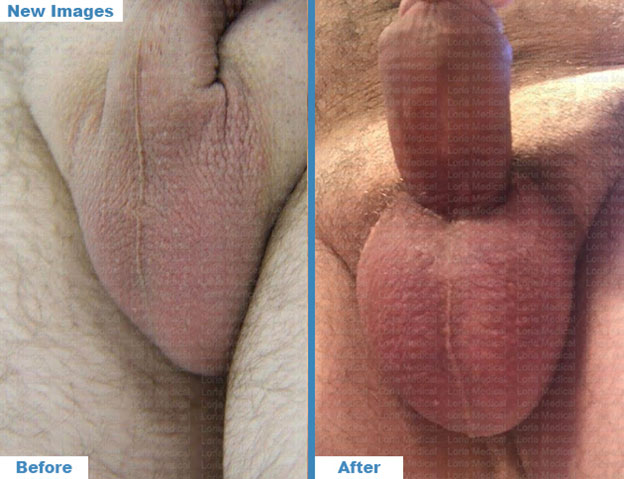 Scrotal-Before-after-2