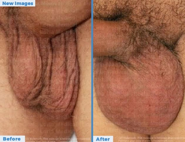 Scrotal-Before-after-3