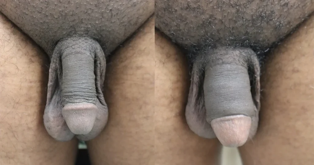 1st session Permanent Girth before-and-after