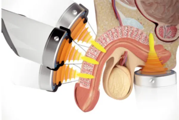 Shockwave for ED procedure diagram